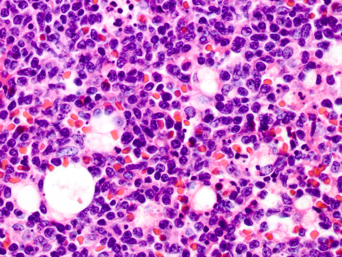 Plasmacytoid dendritic cells, high-power magnification